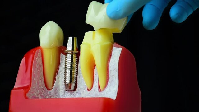 Close-up photo of implant dentistry it is a replacement for missing teeth by dentist hand.