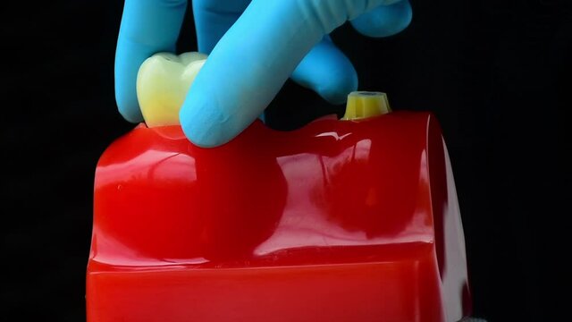Close-up photo of implant dentistry it is a replacement for missing teeth by dentist hand.
