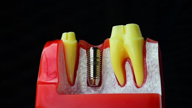 Close-up photo of implant dentistry it is a replacement for missing teeth by dentist hand.