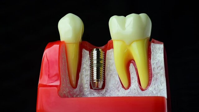 Close-up photo of implant dentistry it is a replacement for missing teeth by dentist hand.