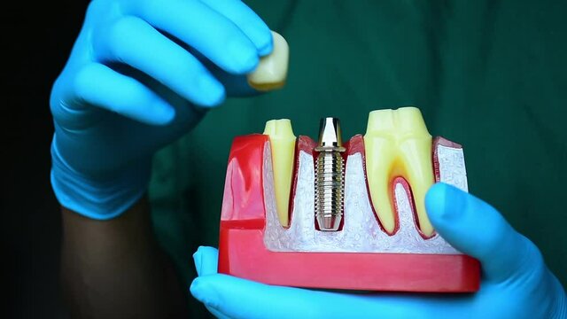 Close-up photo of implant dentistry it is a replacement for missing teeth by dentist hand.