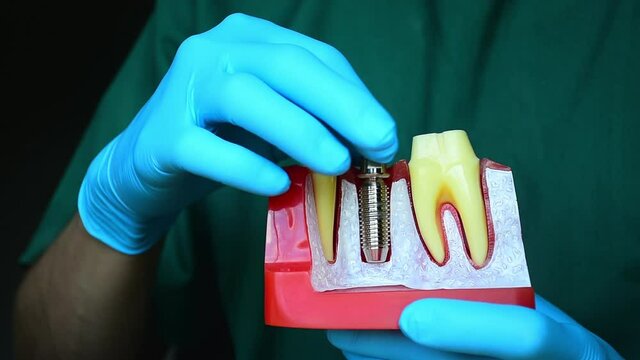 Close-up photo of implant dentistry it is a replacement for missing teeth by dentist hand.