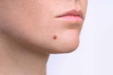 Mole on face. Young woman face with birthmark or nevus. Copy space - obrazy, fototapety, plakaty