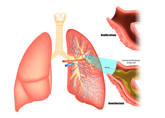 Illustration of lungs affected by bronchiectasis disease. Obstructive lung disease