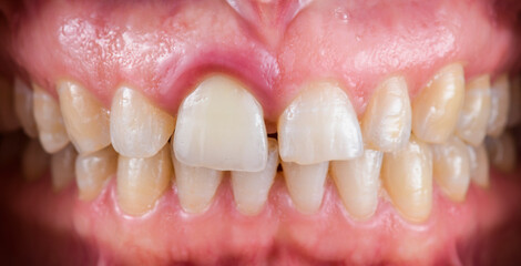 press ceramic crowns and veneers