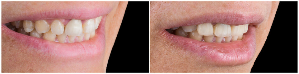 Obraz premium press ceramic crowns and veneers