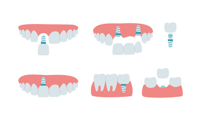 Jaw with healthy teeth and dental implant, dental bridge. Installation process and the scheme of the implant of a molar tooth, an incisor. Set of isolated vector illustrations in flat style - obrazy, fototapety, plakaty