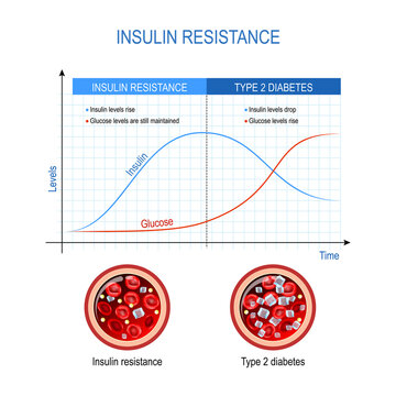 Insulin resistance and Type 2 diabetes