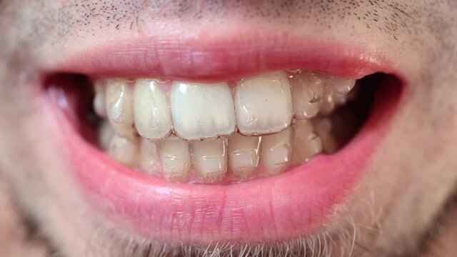 man corrects the bite with aligners showing teeth