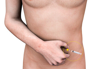Fototapeta premium Subcutaneous injections of heparin on the belly. Bare-chested person and heparin syringe in the abdomen. Preventing blood clots. 3d rendering 