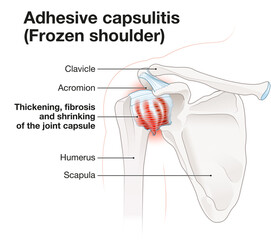 Frozen shoulder. Adhesive capsulitis. Illustration_5