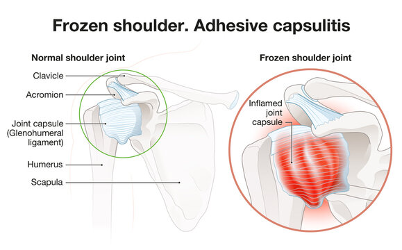 Frozen shoulder. Adhesive capsulitis surgery. Labeled Illustration
