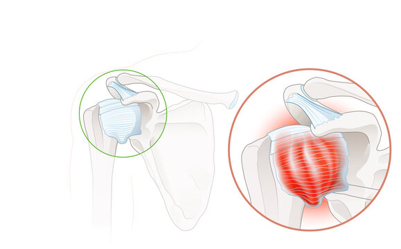 Frozen shoulder. Adhesive capsulitis surgery. Labeled Illustration