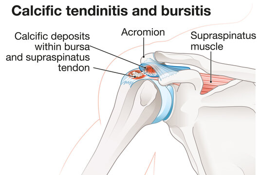 Shoulder Joint. Calcific Tendinitis And Bursitis