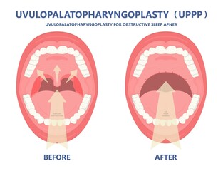 UPPP laser assisted sleep apnea OSA surgery treat tonsil uvula Uvulo Palato Pharyngo Plasty Snoring Oral Excision throat remove mouth Jaw airway study block Nasal obstruction