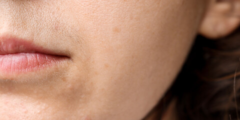 Close-up of a woman's face with a black mustache above the upper lip. Problematic skin, improper care and hirsutism.