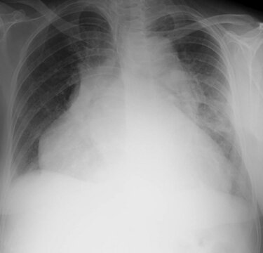 X ray image of cardiomegali radiology 