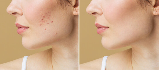Young woman before and after acne treatment. Skin care concept.