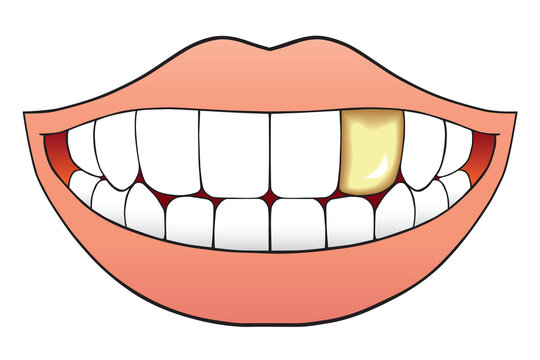 Mouth With Gold Tooth
