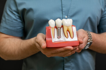 Closeup of the male dentist doctor hands with dental implant model as teaching aid