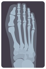 Superior radiograph of human right foot or limb. X-ray picture or radiographic monitor image of metatarsus bones and toes, top view. Medical radiology. Monochrome vector illustration in flat style