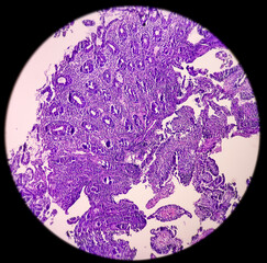 Colon Cancer: Photomicrograph (microscopic image) of colorectum adenocarcinoma,Light microscope 100x showing rectum adenocarcinoma