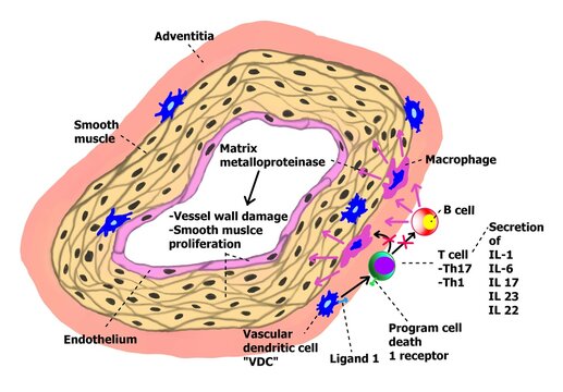 The mechanism of temporal arteritis or giant cell arteritis.