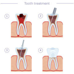 Tooth treatment, step by step instructions. Endodanic treatment, modern dentistry. Vector illustration for dental textbooks