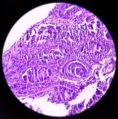 Colon Cancer: Photomicrograph (microscopic image) of colorectum adenocarcinoma,Light microscope 40x showing rectum adenocarcinoma