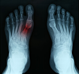 X ray of feet with tarsal fracture closeup
