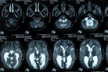 MRI scan or magnetic resonance image of the brain showed obstructive triventricular hydrocephalus. Medical service concept.
