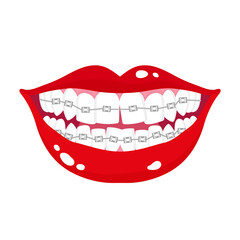 Obraz premium Vector cartoon smiling mouth with stages of crooked teeth alignment using orthodontic metal braces.