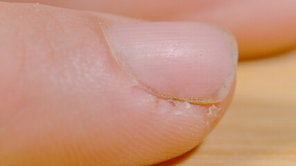 MACRO, DOF: Unrecognizable person's fingers have been damaged by manual labor.