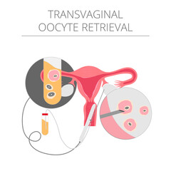 Vector colored illustration Egg retrieval. Egg donation. Donor. In vitro fertilization.