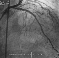 Coronary angiogram (CAG) was performed successful percutaneous coronary intervention (PCI) at left...
