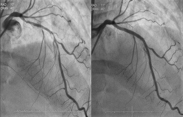 Comparison of pre-post percutaneous coronary intervention (PCI) at proximal to mid left anterior descending artery (LAD) with drug eluting stent (DES). - obrazy, fototapety, plakaty