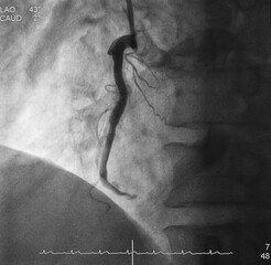 Coronary angiogram (CAG) was performed total occlusion at right coronary artery (RCA).