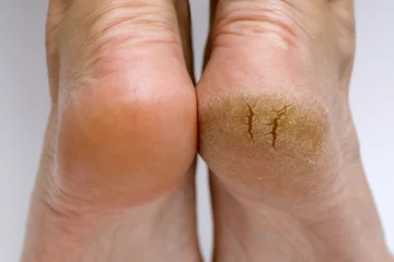 Crédence de cuisine en verre imprimé Pédicure Cracked heels before and after treatment and treatment. Medical pedicure in a beauty salon. Problematic dehydrated feet with dry skin.