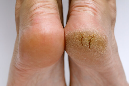 Cracked Heels? This could be why! | Sol Foot & Ankle Centers