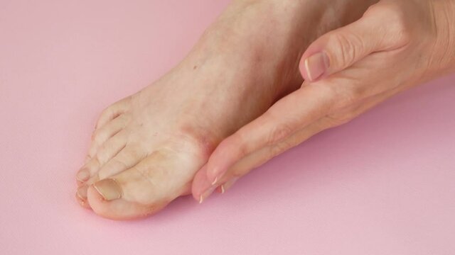 woman's hand massaging her bunion toes in bare feet to relieve pain on pink background Woman feet problem. Hallux valgus.