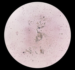 Microscopic view of abnormal urine analysis showing granules casts and uric acid crystal, 40x