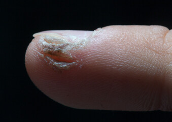 wart on child's finger on black background