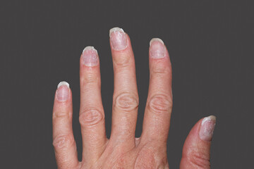 Close- up of bitten and brittle nails without manicure. Overgrown cuticle fingernails and tainted nail plate. Cuticle overgrown nails and damaged nail plate. Concept of nail care and health. - obrazy, fototapety, plakaty