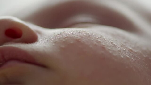 Macro shot of a sleeping childs face affected by diathesis. Troubled face skin of a small caucasian baby.    childs face with skin defect. Closeup footage of babies cheecks. 