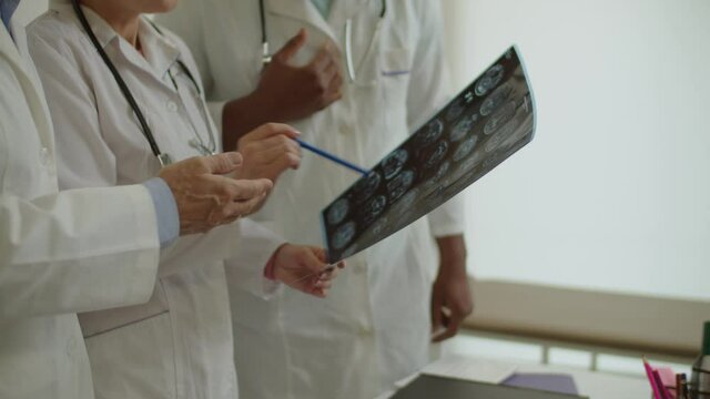 Close-up of hands of diverse multiethnic medical coworkers looking at mri brain scan of ill patient, pointing with pen at damaged area, discussing treatment plan while working at medical office.