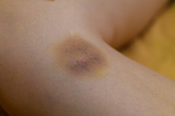 closeup bruise on woman's leg. wounded skip, violence concept