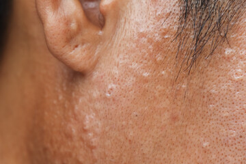 Fototapeta premium Chemicals can harm your skin because you don't wear protective gear and acne