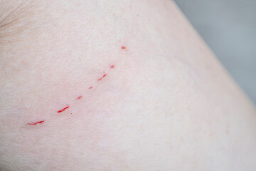 bleeding wound on the skin,  caucasians