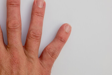 Adult male hand showing distortion and deformity of little finger due to malunion of bone fracture