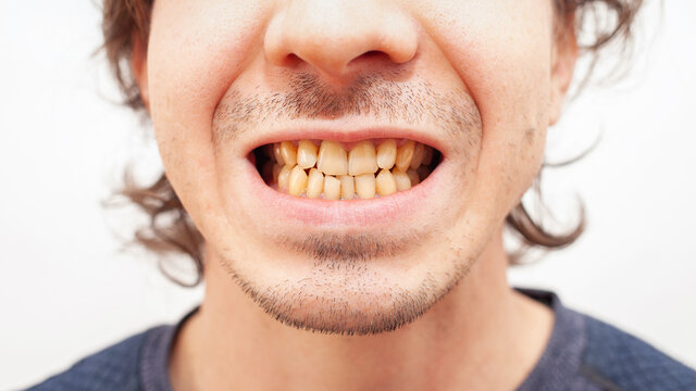Close up portrait smile teeth man. yellow ugly teeth from smoking, alcohol, disease. Crooked dirty